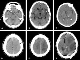 Acute CT Head Course